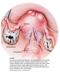 endometriozis-cikolata-kisti-nedir-y8sqyfjL.jpg