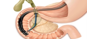 ercp-nedir-X1vZYWZF.jpg