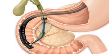 ercp-nedir-X1vZYWZF.jpg