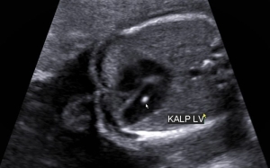 fetal-intrakardiyak-ekojen-odak-nedir-Fai7DBvA.jpg