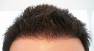 fue-teknigi-ile-sac-ekimi-PkBf8cjk.jpg