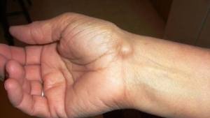 ganglion-kisti-nedir-TB5zXEyC.jpg
