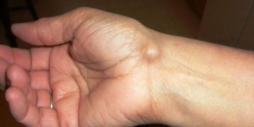 ganglion-kisti-nedir-TB5zXEyC.jpg