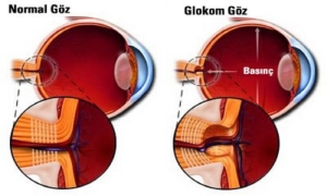 glokom-goz-tansiyonu-nedir-KF5vfzIQ.jpg