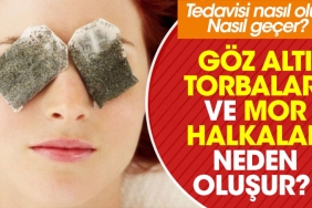 goz-alti-torbalari-ve-mor-halkalar-neden-olusur-tedavisi-nasil-olur-nasil-gecer-7UBAHBET.jpg