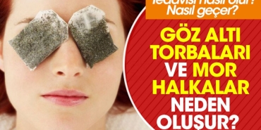 goz-alti-torbalari-ve-mor-halkalar-neden-olusur-tedavisi-nasil-olur-nasil-gecer-7UBAHBET.jpg