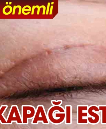 goz-kapagi-estetigi-hakkinda-az-bilinenler-yZs7PAnK.jpg