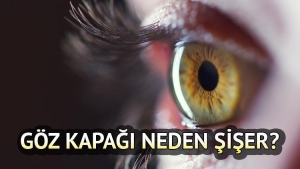 goz-kapagi-neden-siser-nasil-gecer-goz-kapagi-sismesine-ne-l-gelir-Cd6tFXqK.jpg