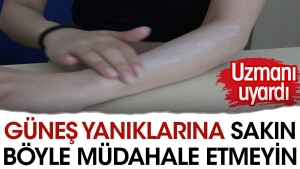 gunes-yaniklarina-sakin-bu-turlu-mudahale-etmeyin-uzmani-uyardi-495BqBI8.jpg