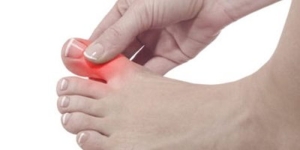halluks-valgus-nedir-mxvTRwnF.jpg