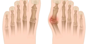 hallux-valgus-nedir-7rSJy2eX.jpg