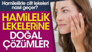 hamilelikte-cilt-lekeleri-nasil-gecer-hamilelik-lekelerine-dogal-tahliller-7SnOWQO3.jpg
