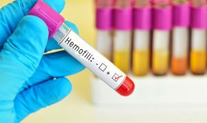 hemofili-nedir-hemofili-belirtileri-neler-YRKCR6dU.jpg