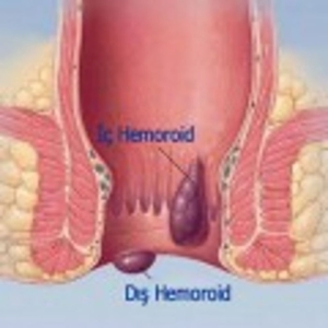 hemoroid-basur-nedir-ZSHGkv7s.jpg