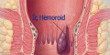 hemoroid-basur-nedir-ZSHGkv7s.jpg