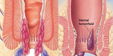 hemoroid-hastaligi-nedir-CLjYLQB9.jpg