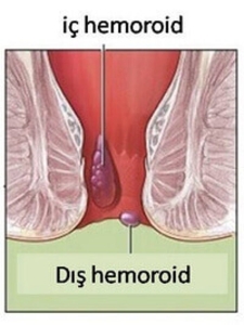hemoroid-nedir-BznrBu3S.jpg
