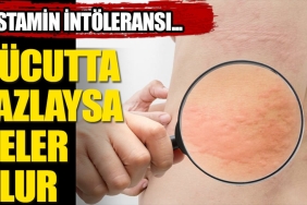 histamin-intoleransi-nedir-vAivAGpf.jpg