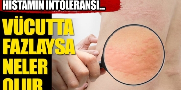 histamin-intoleransi-nedir-vAivAGpf.jpg