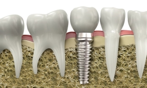 impilantoloji-implant-nedir-yIwpqjUu.jpg