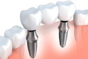 implant-cerrahisi-nedir-cene-cerrahi-kimdir-eksiksiz-implant-tedavisi-nasil-yapilir-1Xl9jGcz.jpg