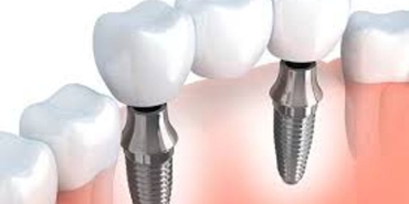 implant-cerrahisi-nedir-cene-cerrahi-kimdir-eksiksiz-implant-tedavisi-nasil-yapilir-1Xl9jGcz.jpg