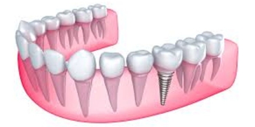 implant-dis-nedir-C4pVtHRg.jpg