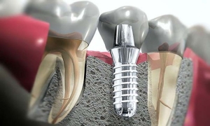 implant-nedir-D5BdQpPs.jpg