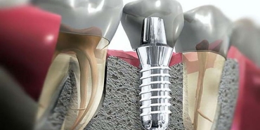 implant-nedir-D5BdQpPs.jpg