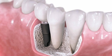 implant-nedir-dd17T52j.jpg