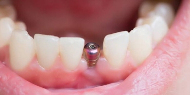 implant-nedir-idnBEPHf.jpg