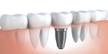 implant-nedir-implant-planlamasi-nasil-yapilir-implant-agrili-bir-yontemmidir-jGN2Uxdp.jpg