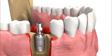 implant-nedir-kimler-yaptirir-nrHXfKIX.jpg