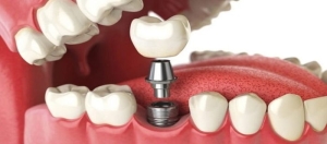 implant-nedir-nHjTOiQe.jpg