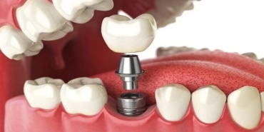 implant-nedir-nHjTOiQe.jpg