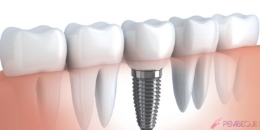 implant-nedir-nasil-uygulanir-6Qjm8Bpv.jpg