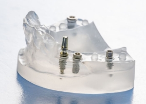 implant-nedir-nasil-uygulanir-DsEOYhAW.jpg