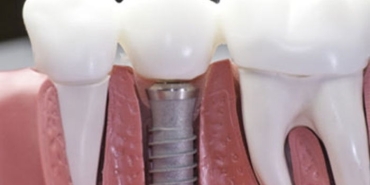 implant-nedir-wgpmiv3H.jpg