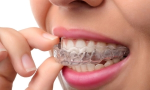 invisalign-nedir-jXPi5b1s.jpg