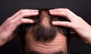 isin-karacanin-hastaligi-ne-alopesi-universalis-hastaligi-nedir-belirtileri-neler-alopesi-universalis-hastaligi-tedavisi-pvdAj8D2.jpg