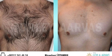 iste-erkeklere-ozel-buz-lazer-epilasyon-icin-eksiksiz-kilavuzumuz-UnjaPGv7.jpg