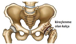 kalca-kireclenmesi-nedir-zGZ8REvP.jpg