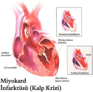 kalp-krizi-nedir-TBXXklqm.jpg