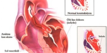kalp-krizi-nedir-TBXXklqm.jpg