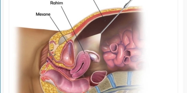 kapali-laporoskopik-teknikle-rahim-alinmasi-histerektomi-nedir-6CkHNk9q.jpg