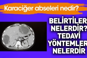 karaciger-abseleri-nedir-belirtileri-nelerdir-tedavi-usulleri-nelerdir-hXvyufXh.jpg