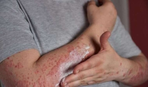 kelebek-hastaligi-nedir-kelebek-hastaligi-lupus-belirtileri-nelerdir-kelebek-hastaliginin-tedavisi-var-mi-kelebek-inWX7PNI.jpg