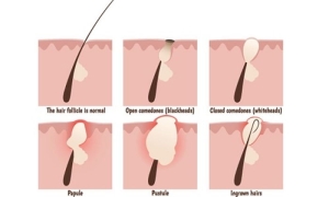 kil-donmesi-nedir-pilonidal-sinus-ZeIPgCv4.jpg