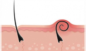 kil-donmesi-pilonoidal-sinus-MZLOkXEI.jpg