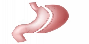 laparoskopik-sleeve-gastrektomi-tup-mide-ameliyati-nedir-t69afniD.jpg